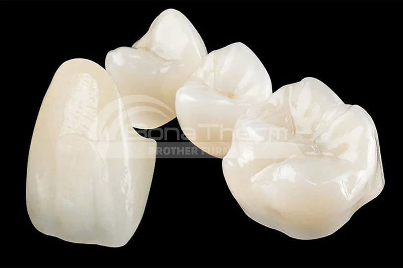 Full-ceramic-crown-onlay-1