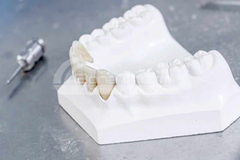 zirconia-denture